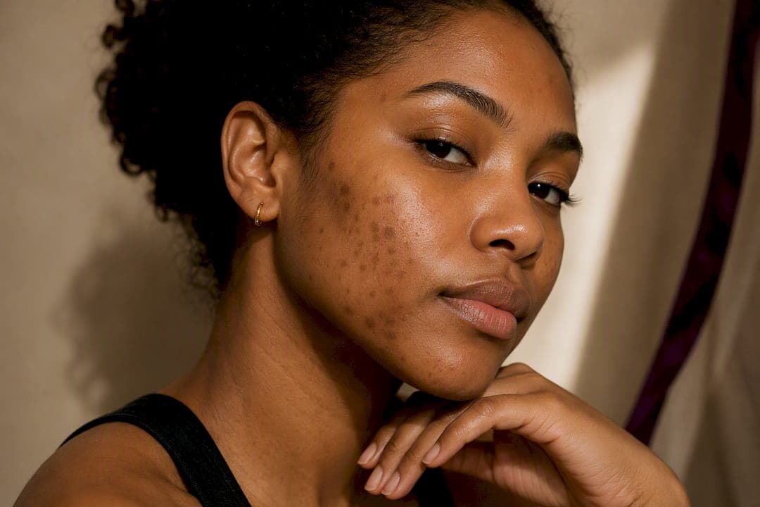 Fade Post-Inflammatory Hyperpigmentation With a Three Step Routine